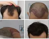 Află despre implantul de păr aici sau de pe site-ul oficial Dr. Felix Hair Implant