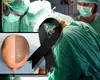 Un bărbat a murit după ce și-a făcut un transplant de păr în Turcia