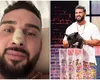 Cum arată nasul lui Dorian Popa după operație. Influencerul și-a dat bandajele jos: „Cum nici nu am visat. O respirație impecabilă”