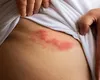 Factori care pot favoriza apariția herpesului zoster