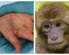 Carantină de 21 de zile pentru varioala maimuţei. Situaţia este mai gravă ca la pandemia de Covid