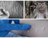 Noi cazuri de variola maimuţei în România. Este vorba despre doi bărbaţi din Bucureşti