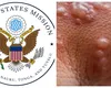 Ambasada SUA, alertă după creşterea numărului de infecţii cu variola maimuţei în România. Recomandări stricte pentru cei care vor să viziteze ţara noastră