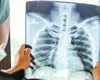 Explozie a cazurilor de pneumonie în România