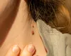 O femeie a învins melanomul după ce şi-a scos 100 de aluniţe