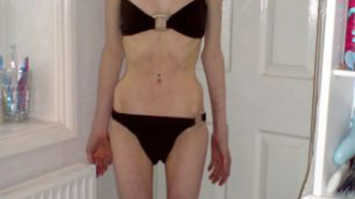 Şocant. Cum arată o tânără care cântăreşte 30 de kilograme FOTO