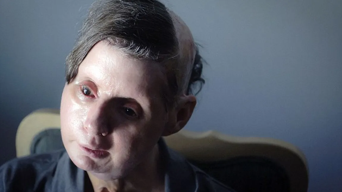 ŞOCANT. Cum arată o femeie la trei ani după ce a fost desfigurată de un cimpanzeu GALERIE FOTO