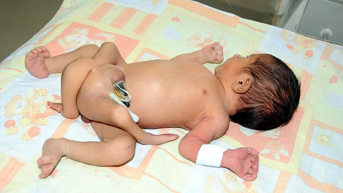 Caz ŞOCANT în Pakistan: Un copil s-a născut cu şase picioare