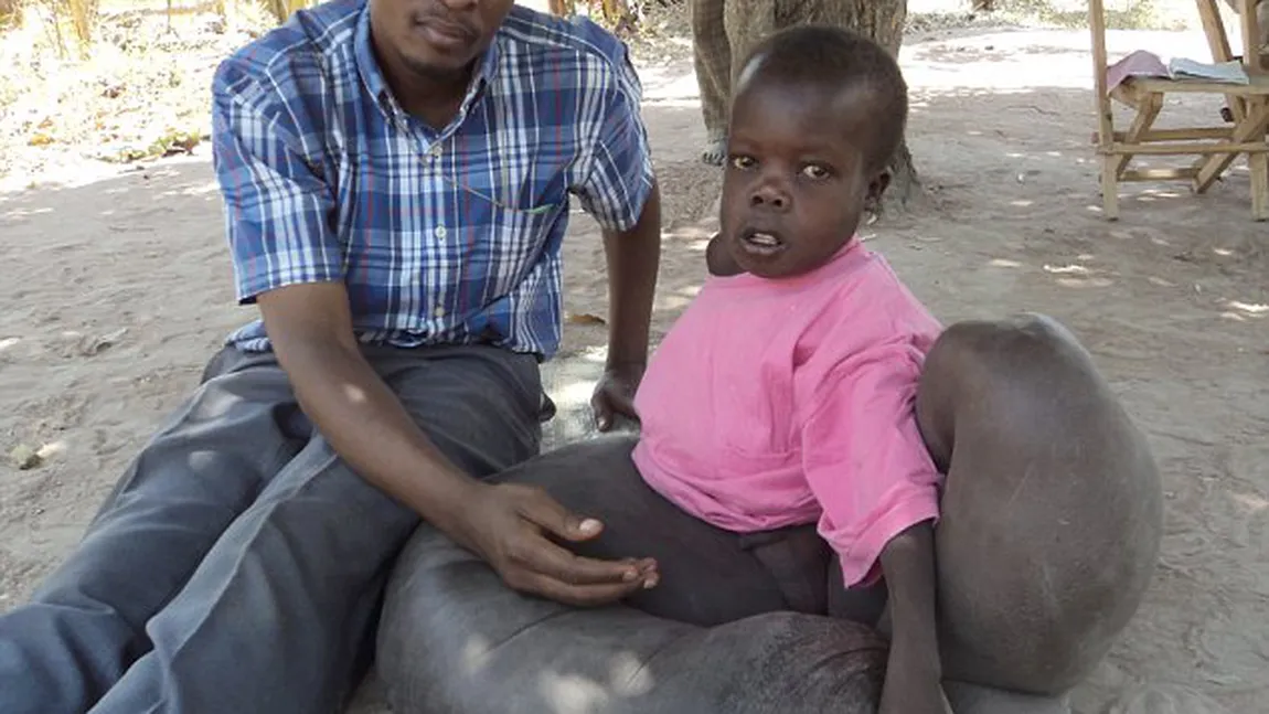 Un băiat din Uganda are o boală care i-a făcut picioarele 