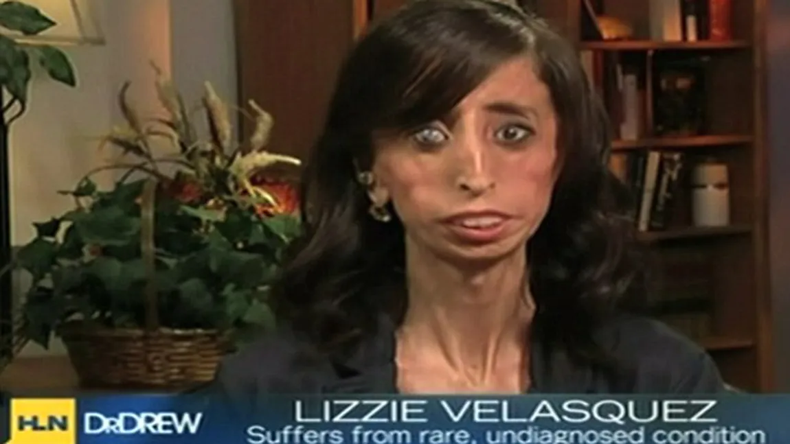 Lizzie Velasquez, 