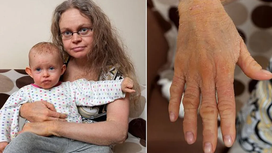 Drama unei femei care dă jos 12 kilograme de piele în fiecare an. Fiica ei i-a moştenit boala