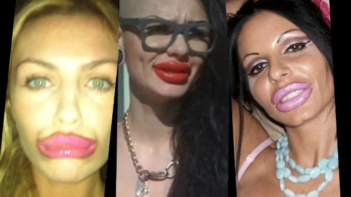 Femei cu buze gigantice: Au vrut să fie mai SENZUALE, dar s-au transformat în adevăraţi MONŞTRI