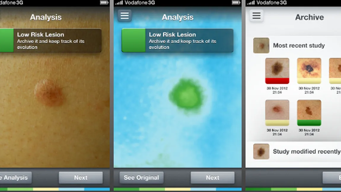 SkinVision, aplicaţia de mobil care poate detecta aluniţele periculoase