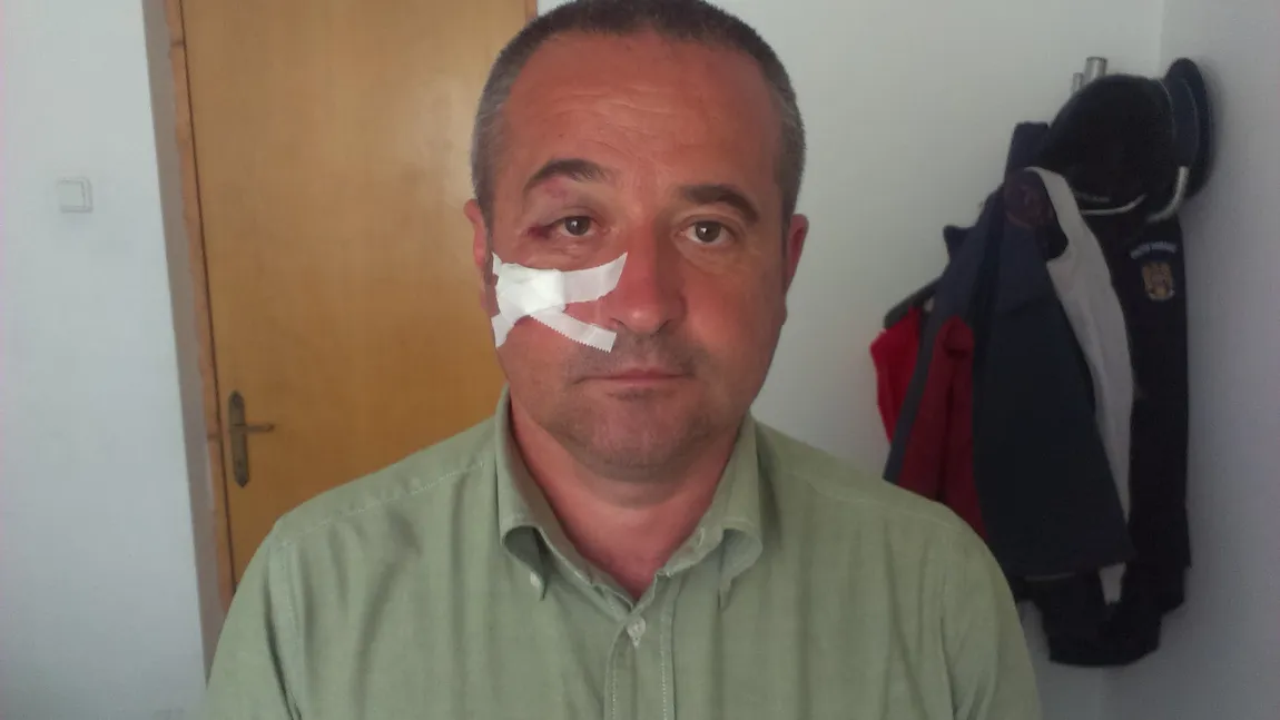 Un ziarist din Vatra Dornei a reclamat la Poliţie că a fost lovit de un consilier local FOTO