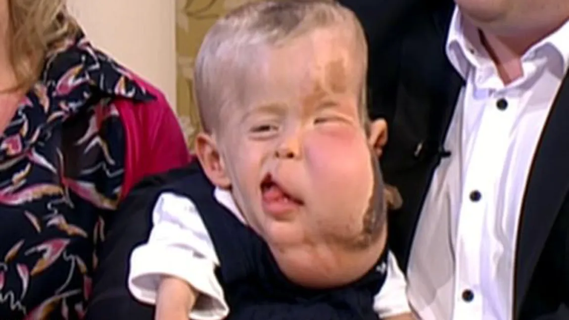 Un băieţel de 2 ani i-a uimit pe medici cu boala lui extrem de rară. Nu se ştie încă de ce suferă