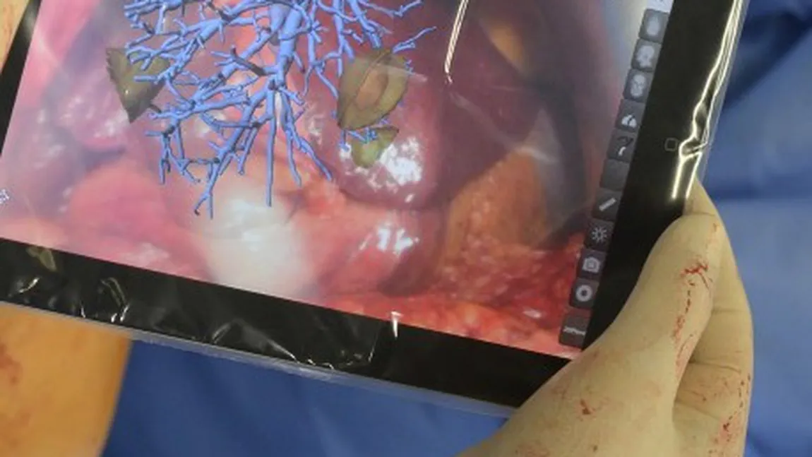 Avans tehnologic: Operaţie de ficat, realizata cu o aplicaţie iPad