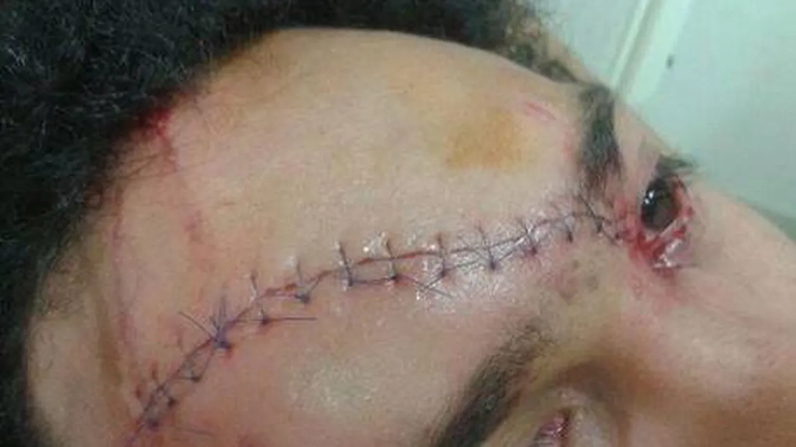 Accidentare HORROR: Fruntea i-a fost cusută cu 13 copci FOTO
