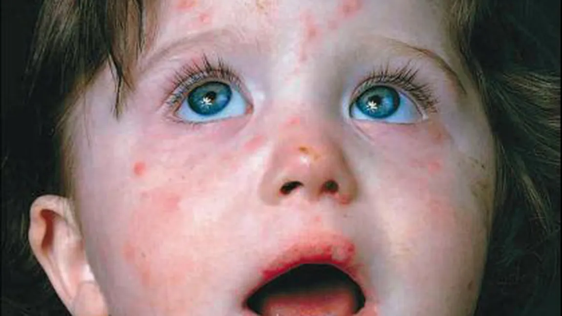 Scarlatina la copii: Simptome, cauze, tratament şi prevenire