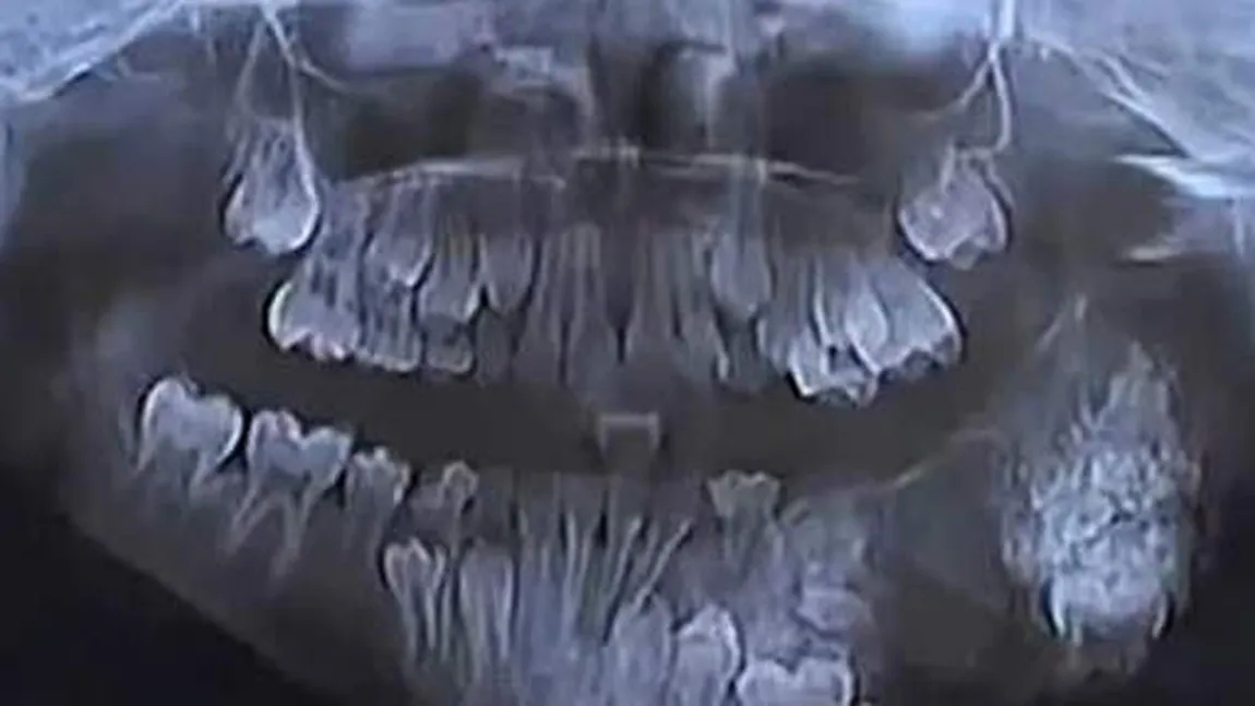 Operaţie incredibilă. Medicii au extras 80 de dinţi din maxilarul unui copil VIDEO