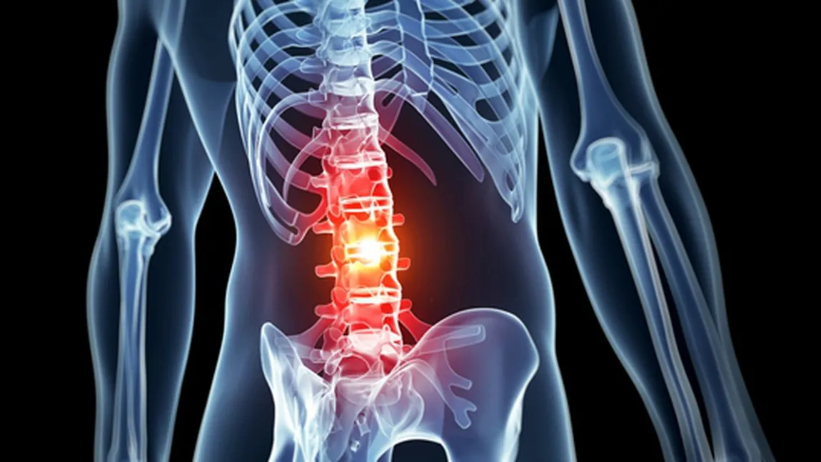 9 remedii naturale pentru dureri de spate