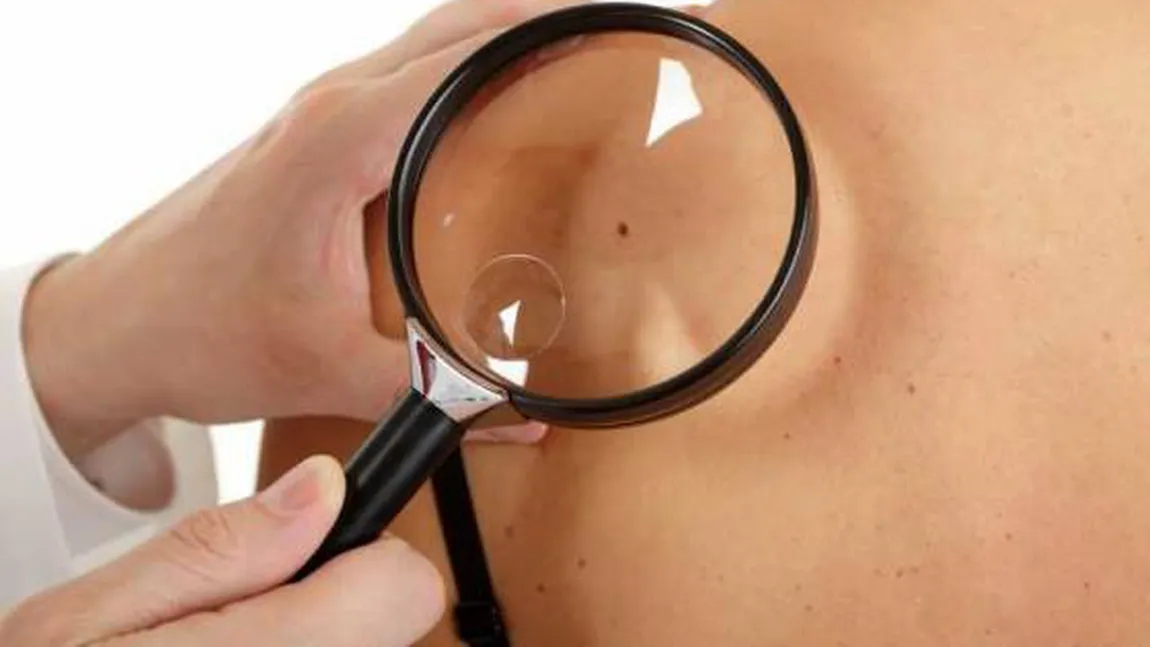Cum detectezi semnele timpurii ale unui cancer de piele