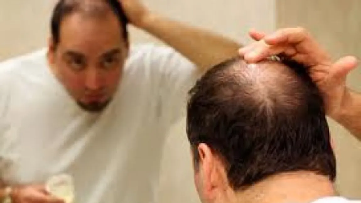 Aproape jumătate dintre bărbaţii din România se confruntă  cu probleme legate de căderea părului