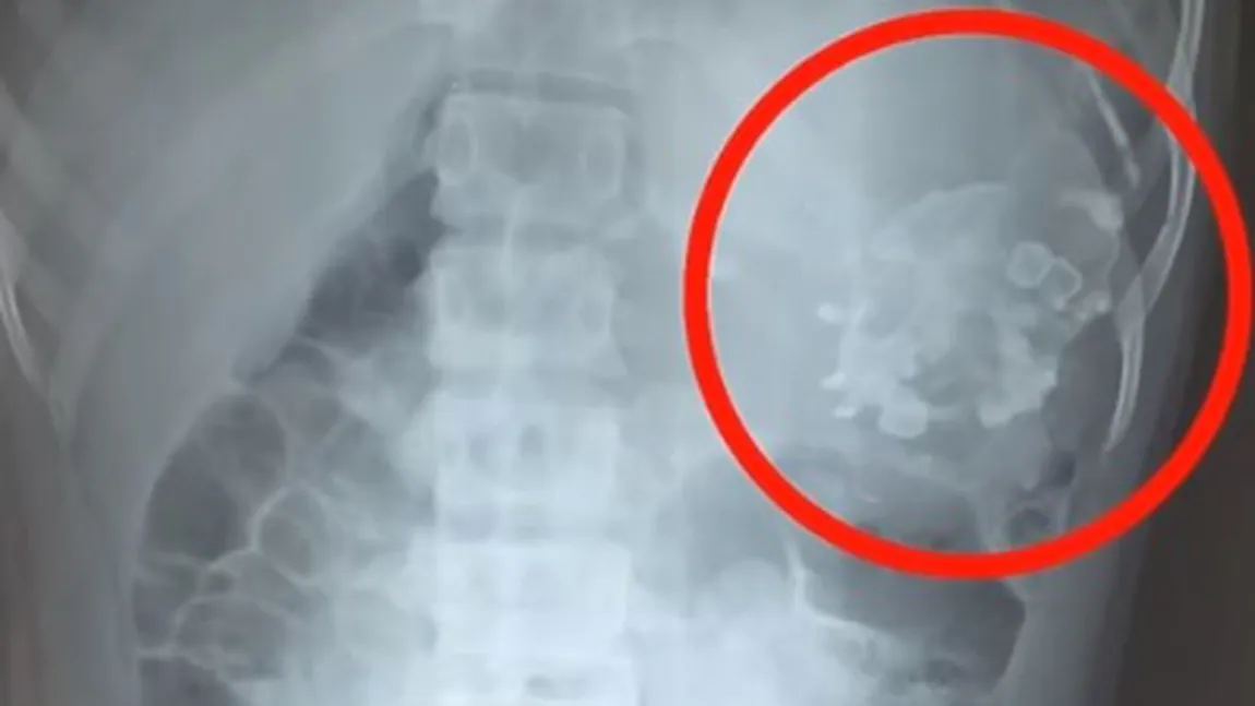 ŞOCANT. Un fetus de 2,5 kilograme a fost scos din abdomenul unui adolescent VIDEO