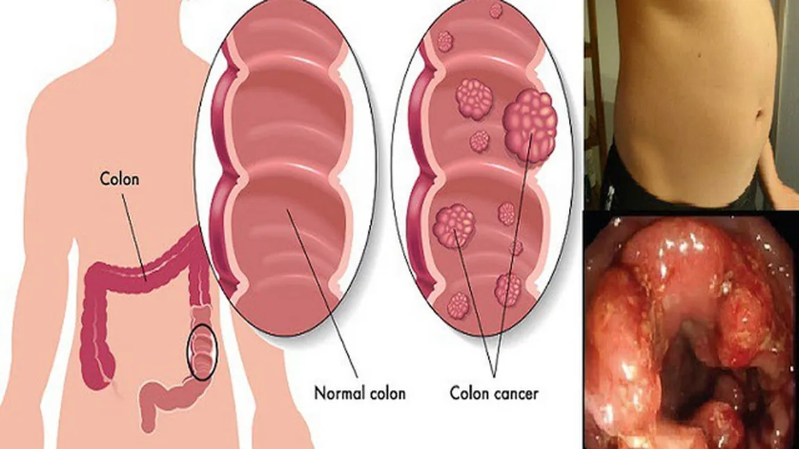 Din 20 de persoane, una prezintă riscul de a face cancer la colon. Iată semnele cutremurătoare ale acestei boli