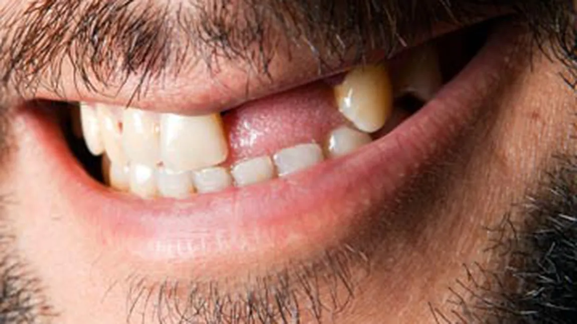 DATE ALARMANTE. Jumătate dintre români îşi pierd dinţii până la 40 de ani