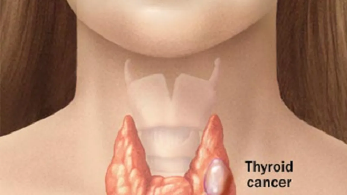 Cancerul de tiroidă. Cine e predispus să dezvolte această boală
