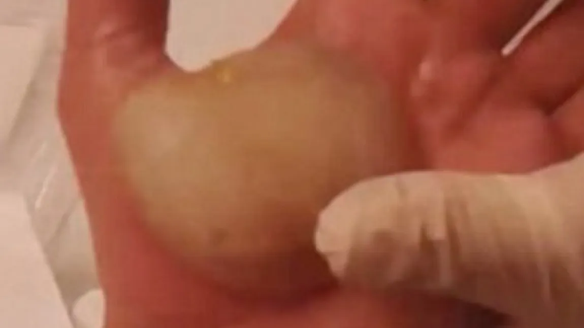 Avea o băşică imensă în palmă. A înţepat-o cu un ac, MARE GREŞEALĂ! Ce a urmat l-a îngrozit VIDEO