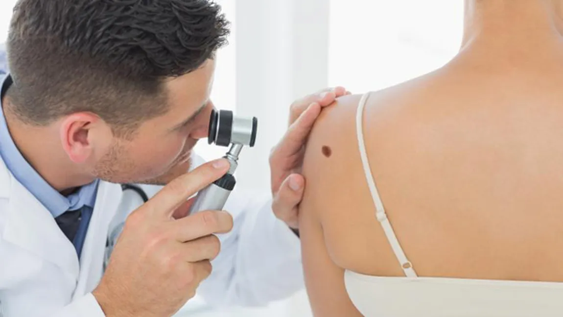 Cancerul de piele: experţii pun la îndoială utilitatea screening-ul anual