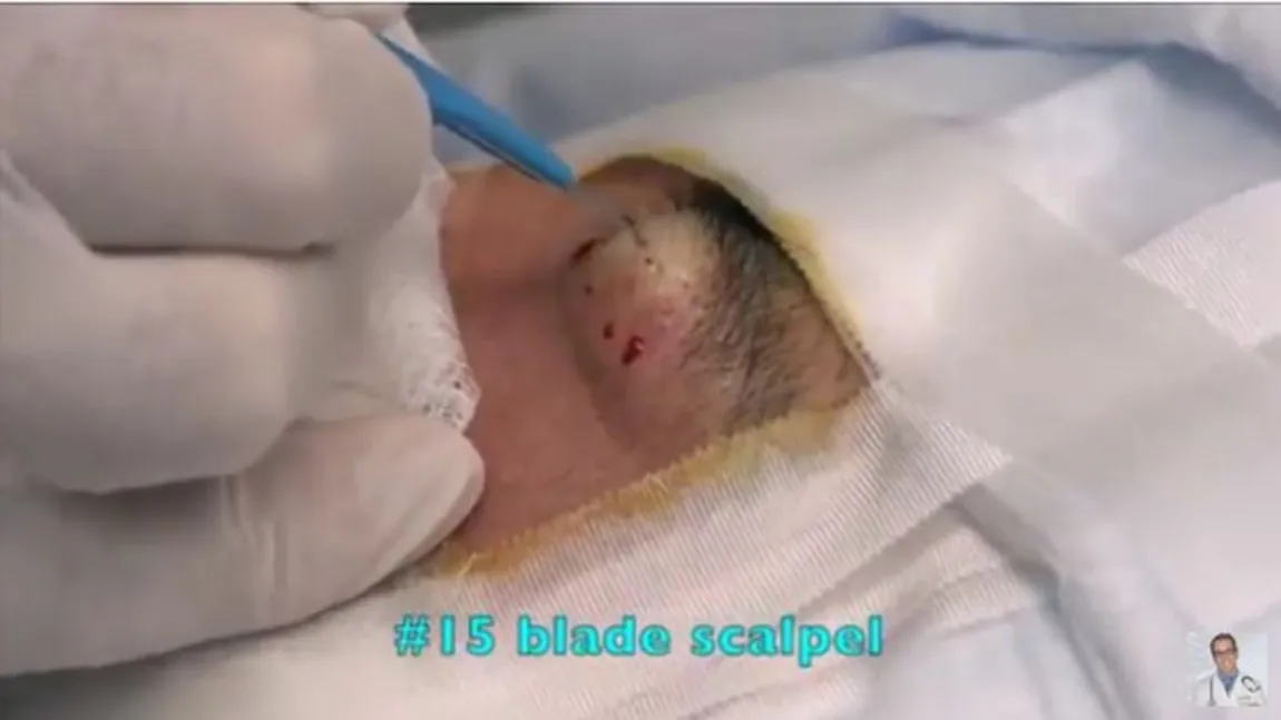 Ani de zile a stat cu o umflatură deasupra ochiului, neştiind ce are acolo. Ce se afla în interior VIDEO