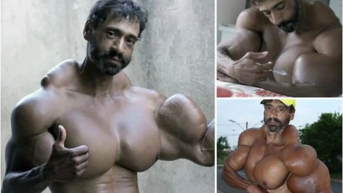Îşi injectează zilnic ulei în braţe, ca să arate ca Hulk. Monstrul din Sao Paolo îşi riscă viaţa pentru celebritate VIDEO