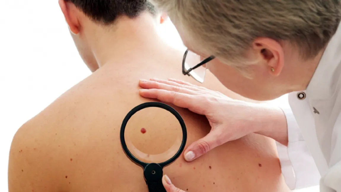 Biopsia creşte şansele de vindecare în cancerul de piele. Vezi cum se face această analiză şi cât este de importantă