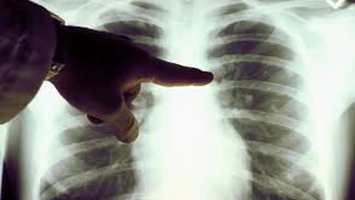 Tot mai mulţi români mor din cauza cancerului pulmonar. 17,5% mai multe decese în 2015 faţă de 2012