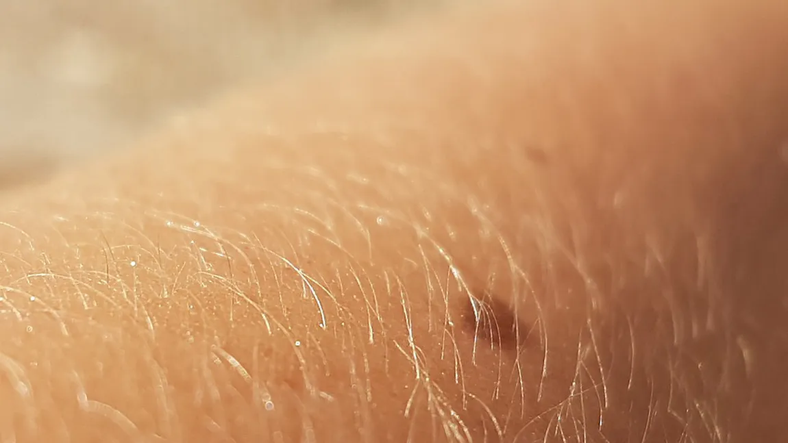 SEMNE CIUDATE ale cancerului de piele greu de identificat