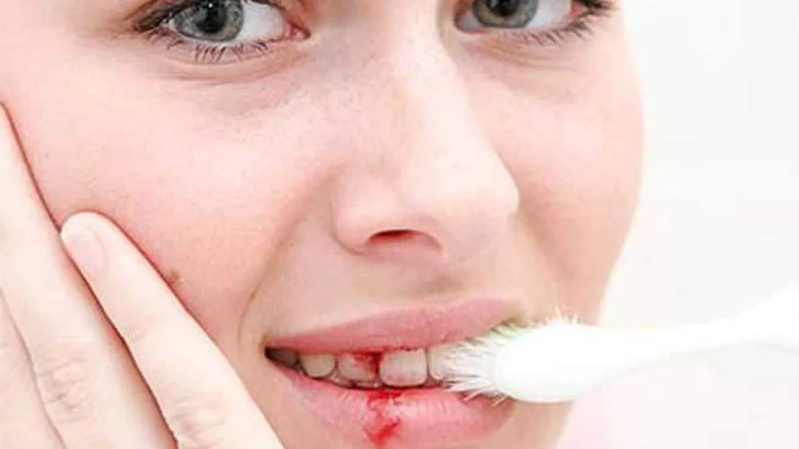 5 situaţii care cauzeaza sângerarea gingiilor
