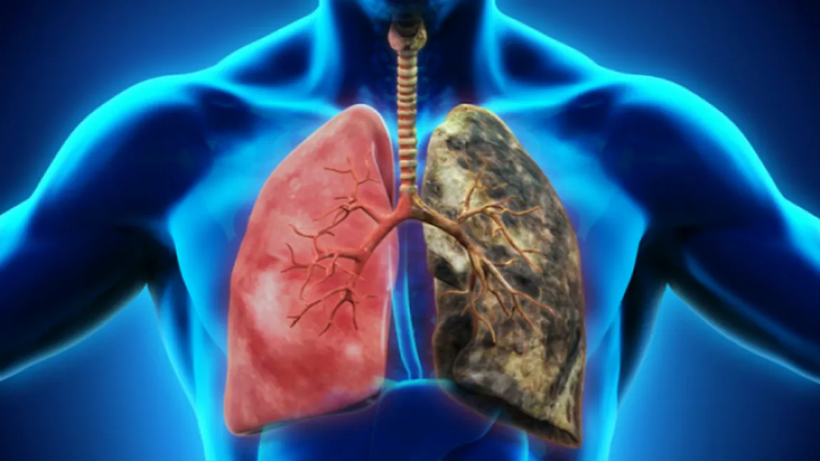 Un român moare în fiecare oră de cancer pulmonar: 