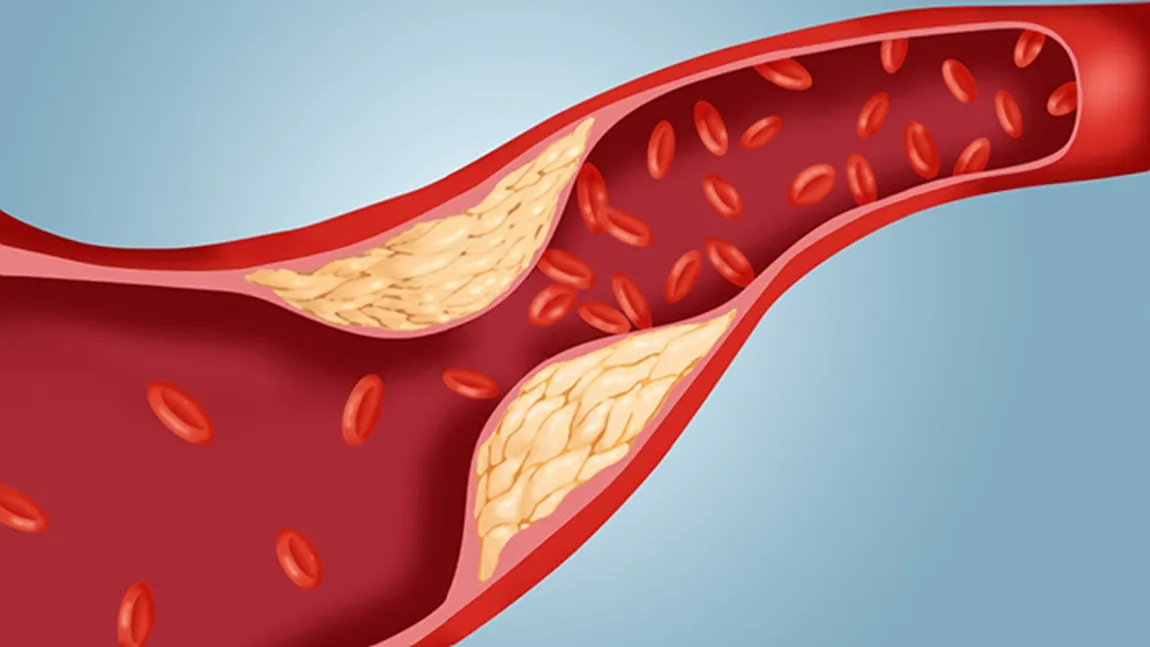 Cum îţi poţi curăţa vasele de sânge de colesterol în doar 40 de zile