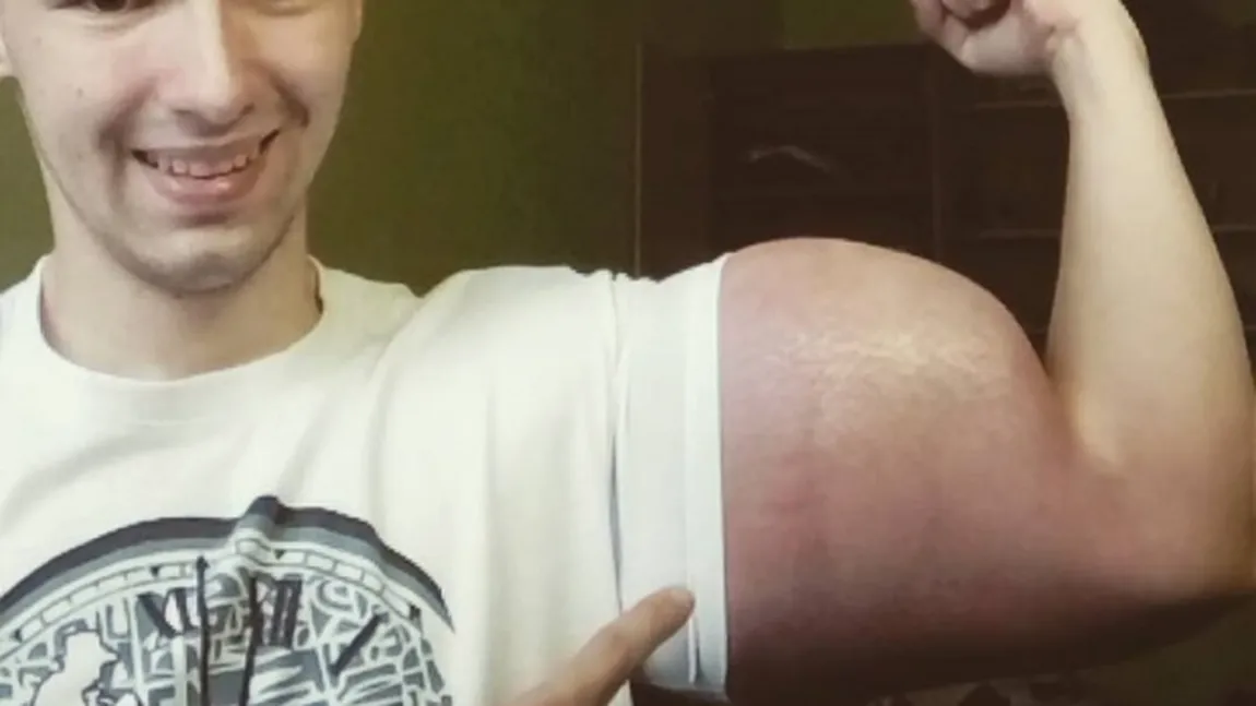 Şi-a injectat o substanţă pentru a avea bicepşi de 60 de cm. Ce i s-a întâmplat este şocant VIDEO
