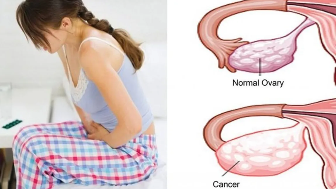 Simptomele cancerului ovarian, 
