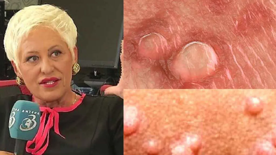 Lidia Fecioru oferă leacul săptămânii: Cum poți trata chisturile ovariene şi fibromatoza uterină
