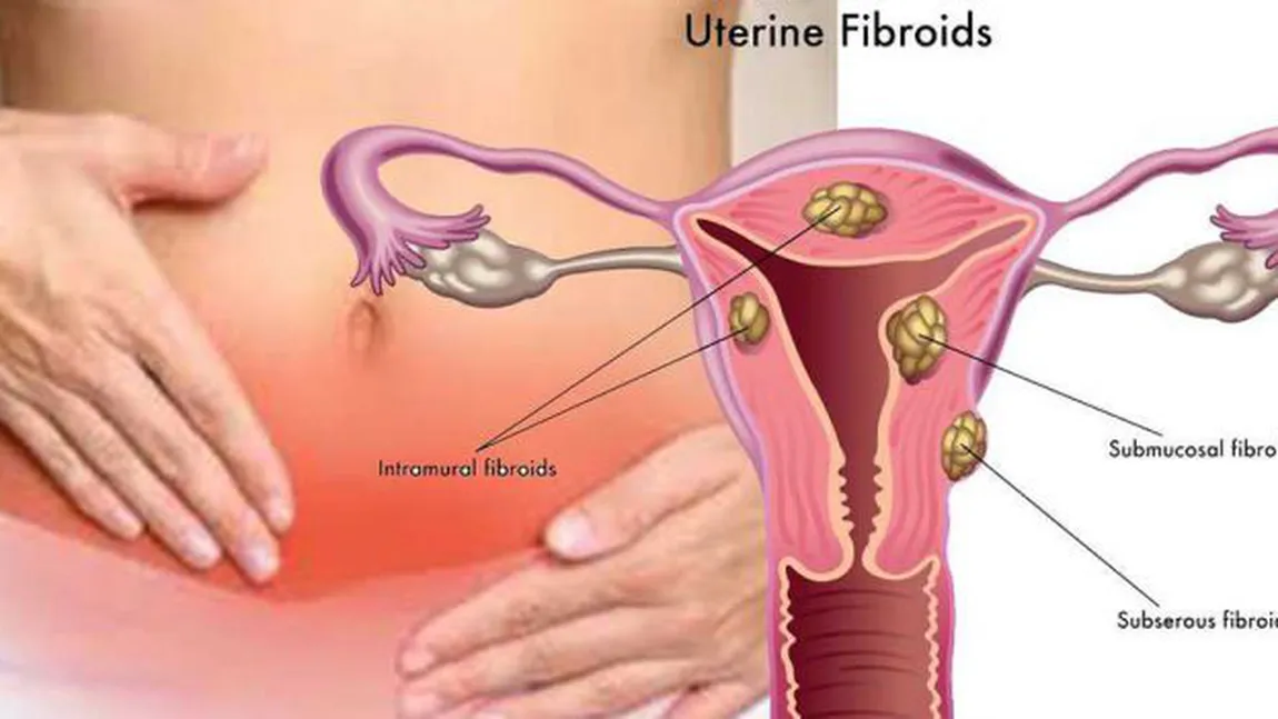 Ce soluţii există pentru a trata fibromul uterin şi pentru a creşte şansele de obţinere a unei sarcini