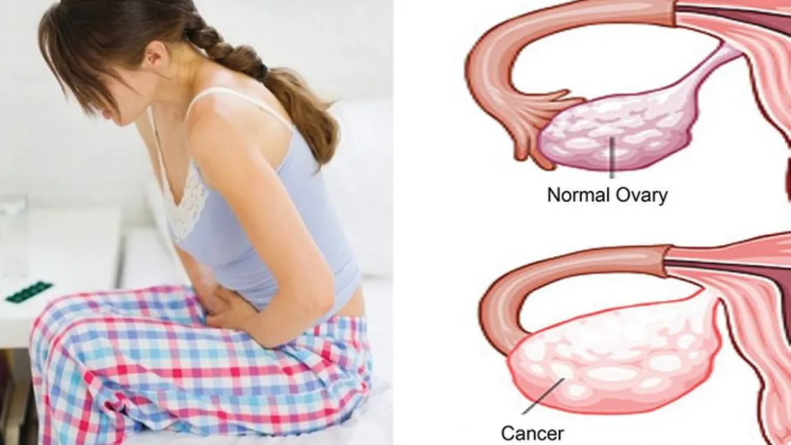 Cancer ovarian. Tot ce trebuie să ştii despre această boală
