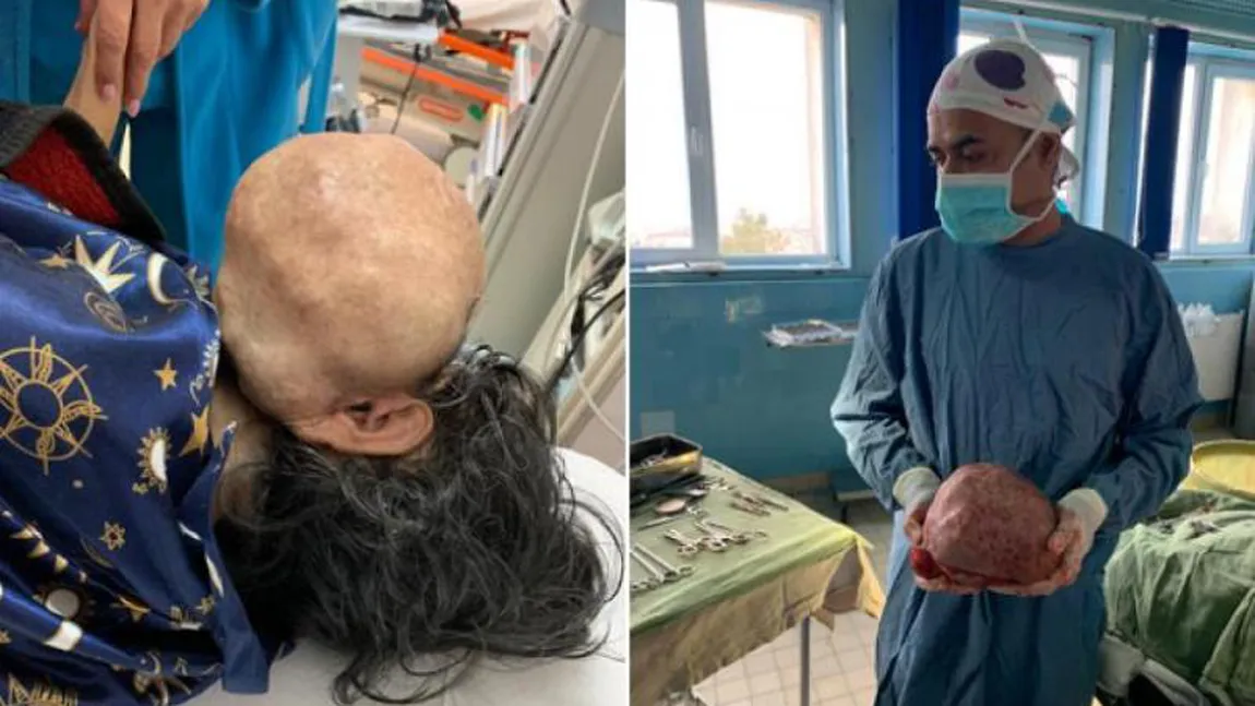 Medicii din Caransebeş au extirpat de pe faţa unei femei o tumoră gigant de 3 kilograme