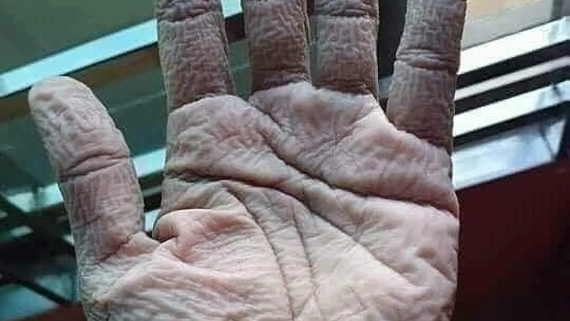 Imagini şocante! Cum arată mâinile cadrelor medicale după ce au stat ore întregi în combinezoanele anti-COVID-19 FOTO