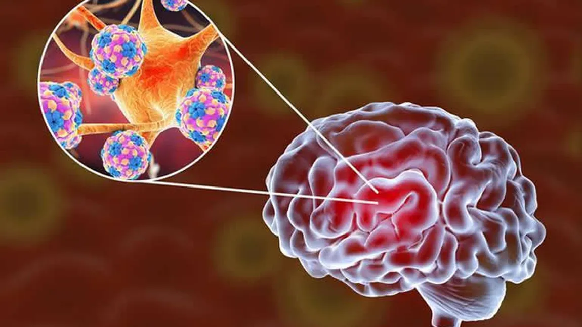 STUDIU Durerile de cap, starea de confuzie, delirul, rezultatul unei invazii a coronavirusului la nivelul creierului