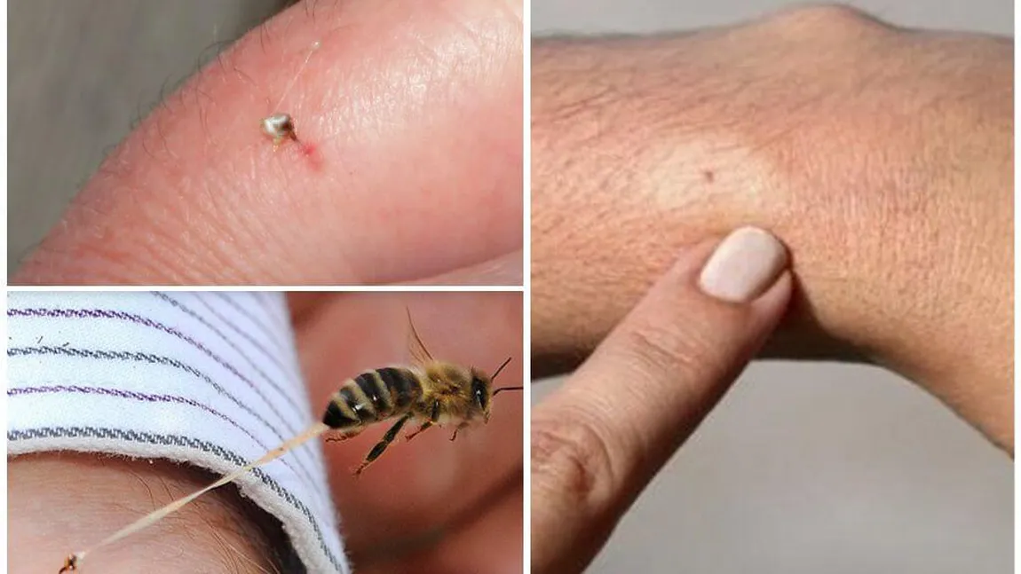Ce faci dacă te înţeapă o albină. 10 lucruri care vă pot salva viața. Ce să (NU) faci în astfel de situații