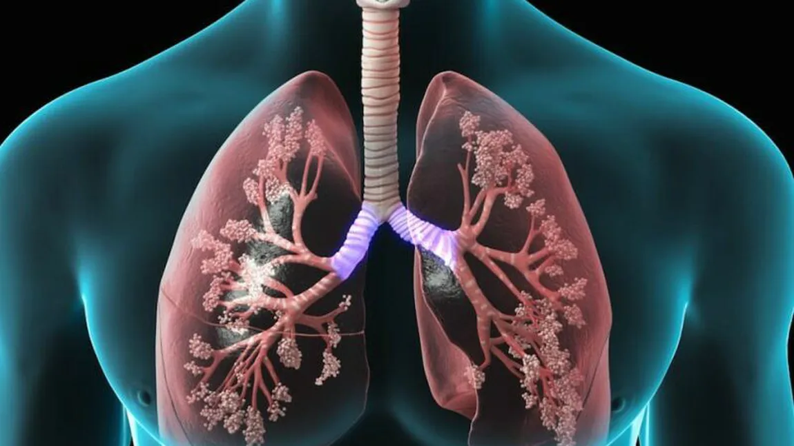 Ce este embolismul pulmonar. Această afecţiune poate cauza decesul pacienților cu forme grave de COVID-19